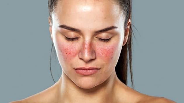 Life With Lupus