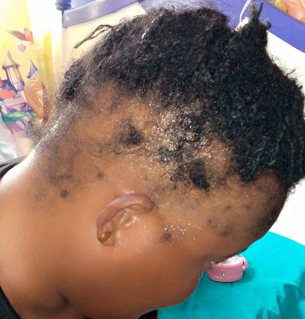 HIV causes severe hair loss as Susan experienced.